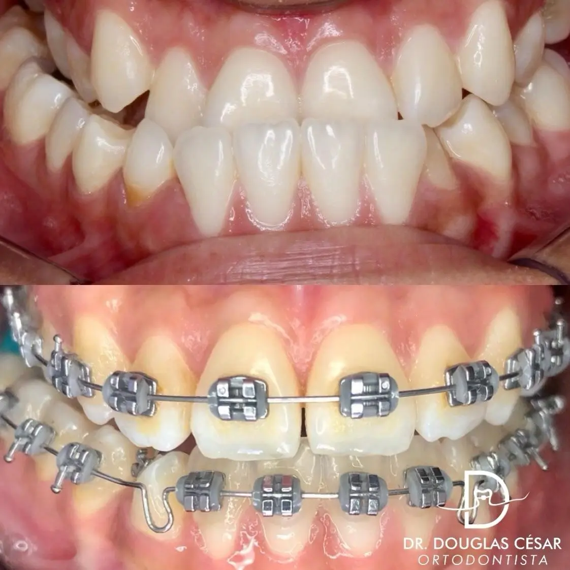 Antes e depois de tratamento com aparelho fixo metálico — caso real do Dr. Douglas César, Pará de Minas/MG