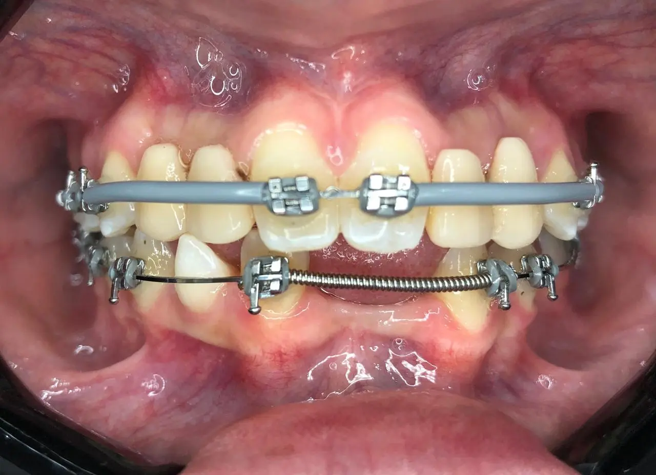 Aparelho fixo metálico com mola fechando espaço entre os dentes