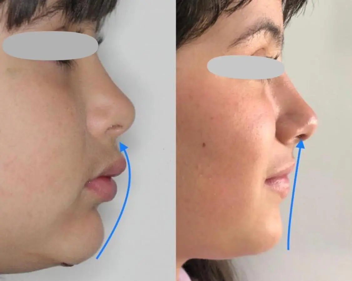 Comparativo de perfil facial infantil em acompanhamento de ortopedia funcional dos maxilares