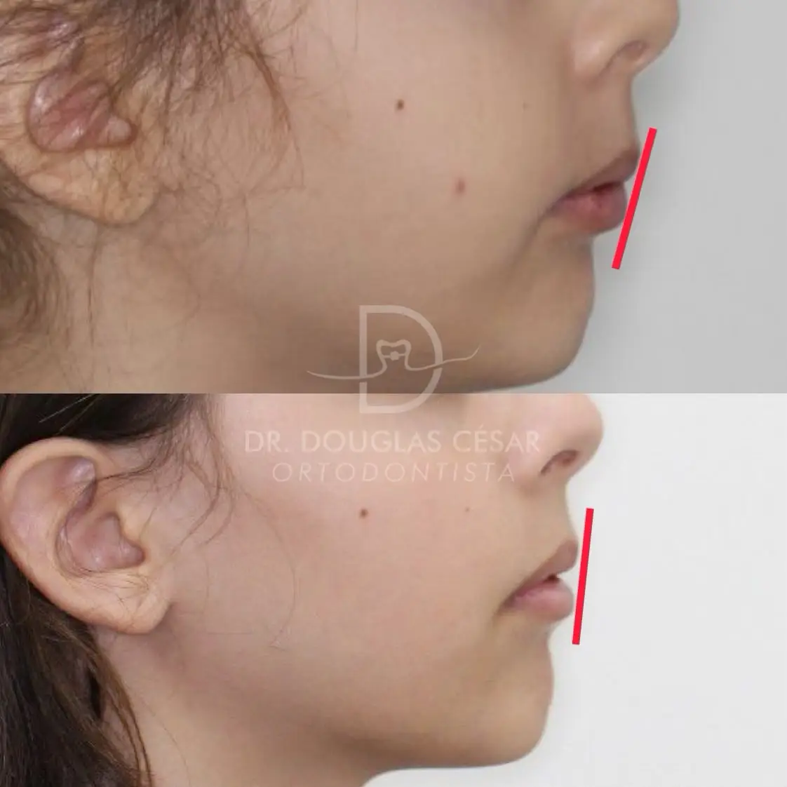 Comparativo de perfil facial infantil em caso clínico de ortopedia funcional dos maxilares