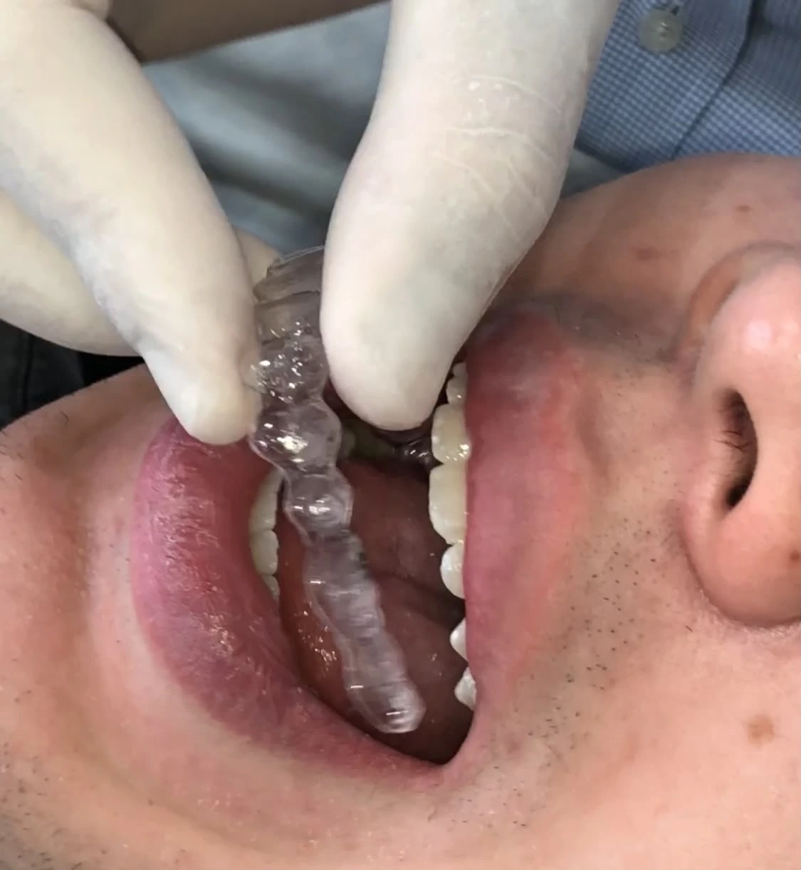Colocação de alinhador transparente Invisalign durante orientação de uso