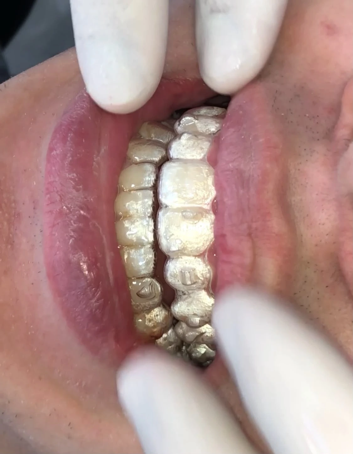Alinhador transparente Invisalign em uso durante tratamento ortodôntico