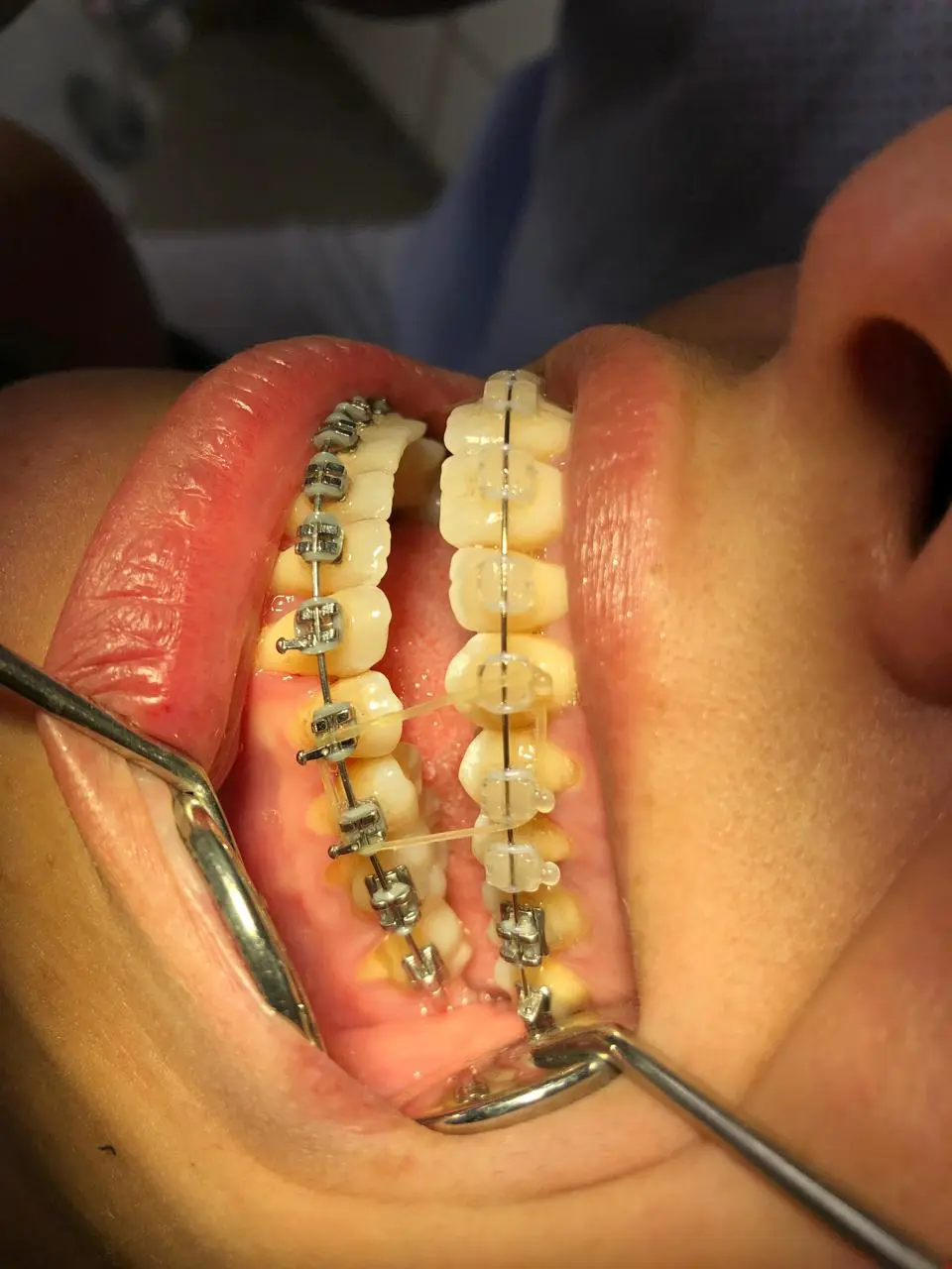 Aparelho fixo em vista lateral com elásticos intermaxilares, arcada estética e metálica durante o tratamento