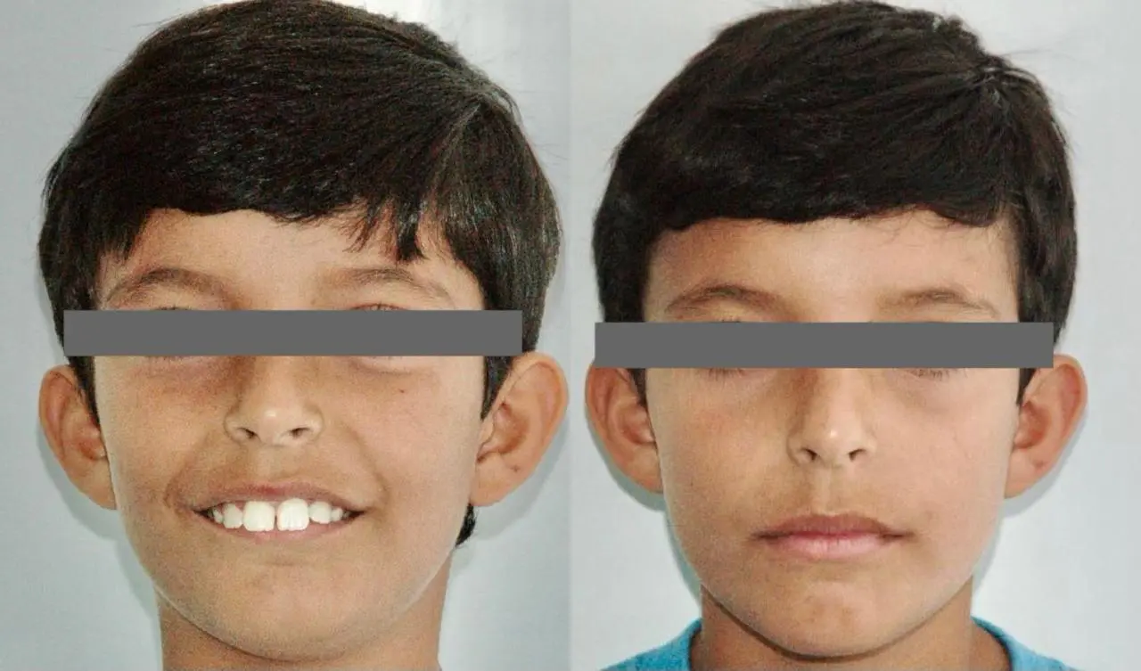 Comparativo frontal de desenvolvimento facial infantil em acompanhamento de ortopedia funcional dos maxilares
