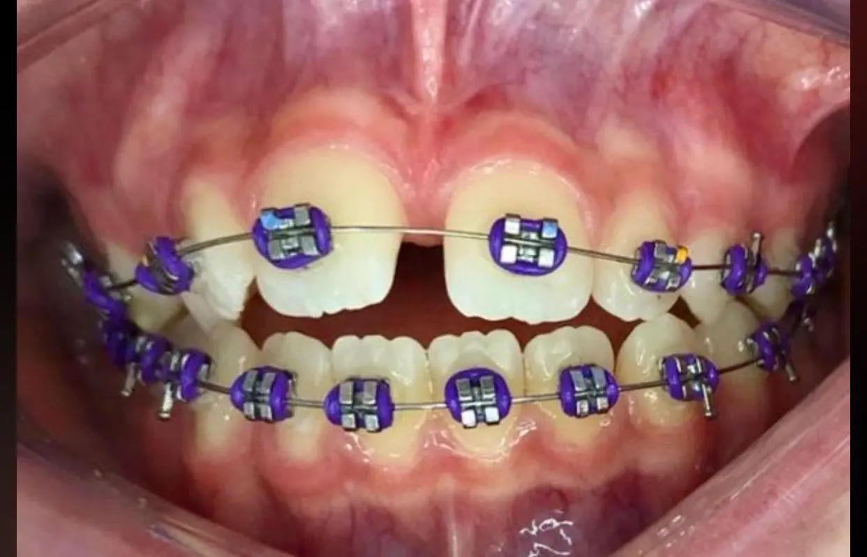 Aparelho fixo metálico com elásticos coloridos roxos