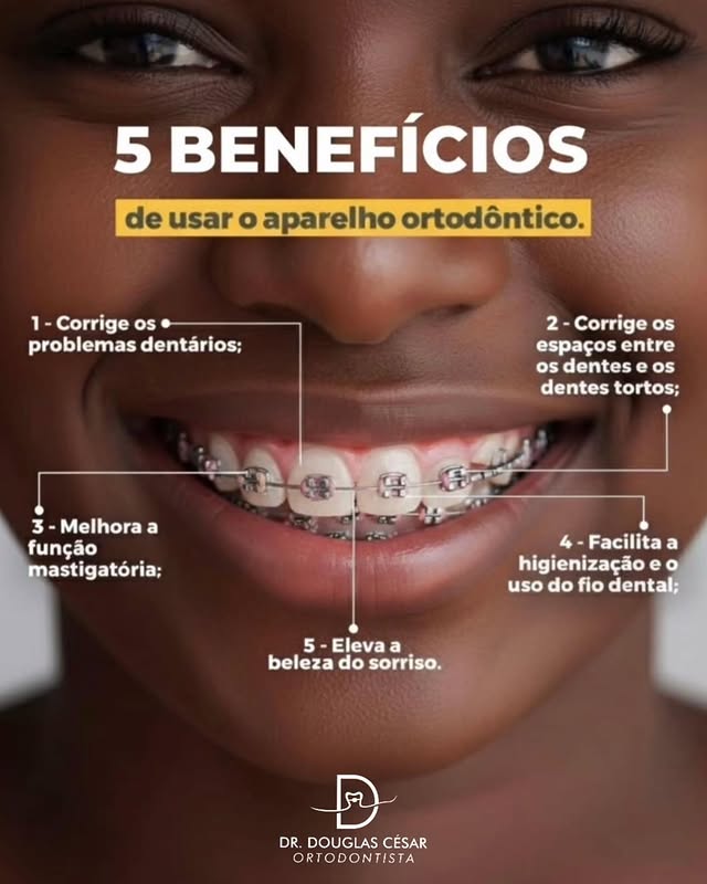 Post sobre os 5 benefícios de usar aparelho ortodôntico