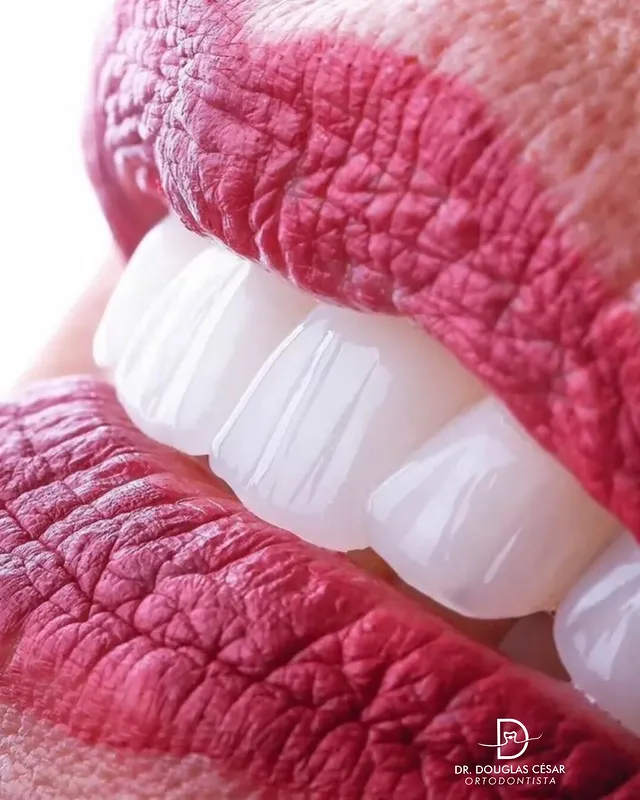 Detalhe de sorriso com acabamento estético após tratamento ortodôntico